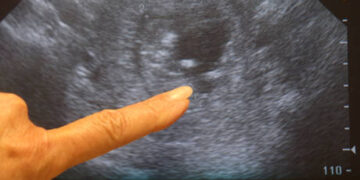 Abortion an ‘acute’ problem in Russia – Putin