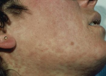 Rare virus with no cure detected in New York