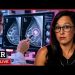 Do Mammograms Really Save Lives?
